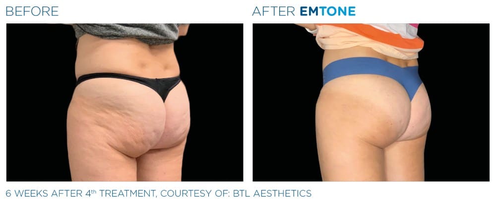 Emtone results before and after treatment at Capitol Contours in Alexandria, VA.