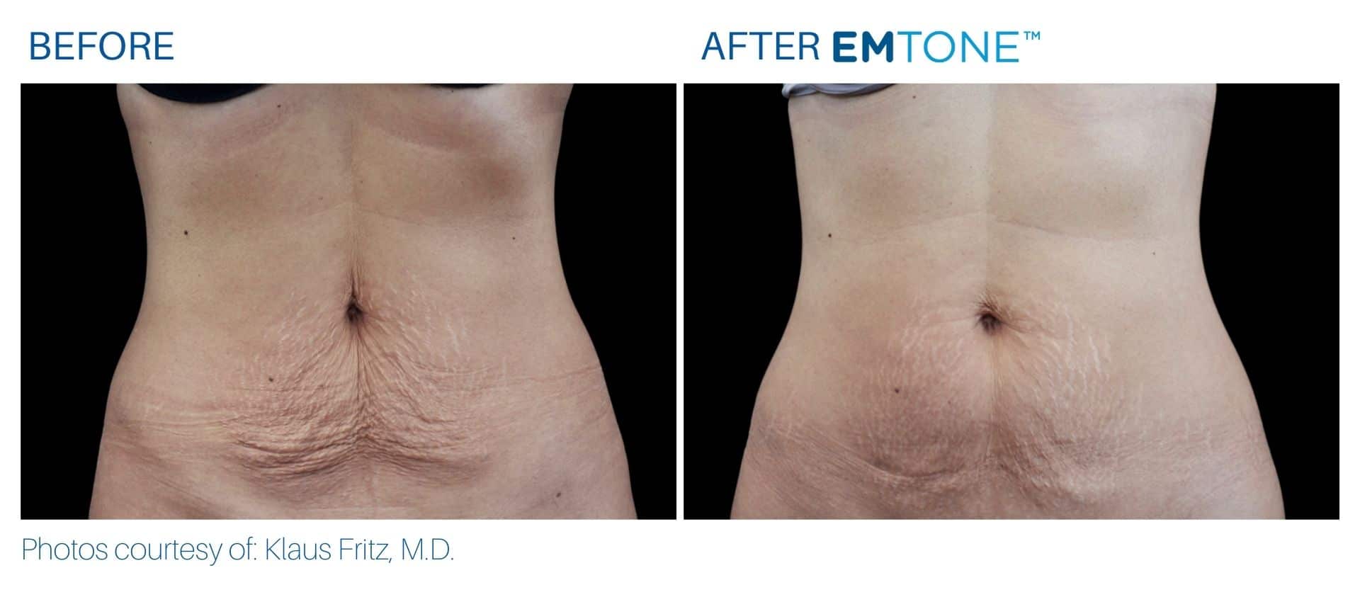 Emtone treatment on the abdomen before and after treatment on abdomen at Capitol Contours in Alexandria, VA.