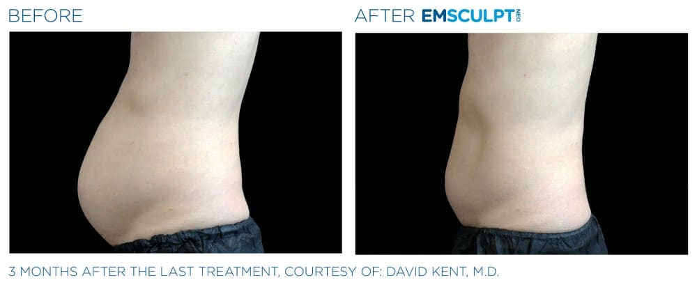 Emsculpt before and after results at Capitol Contours in Alexandria, VA.