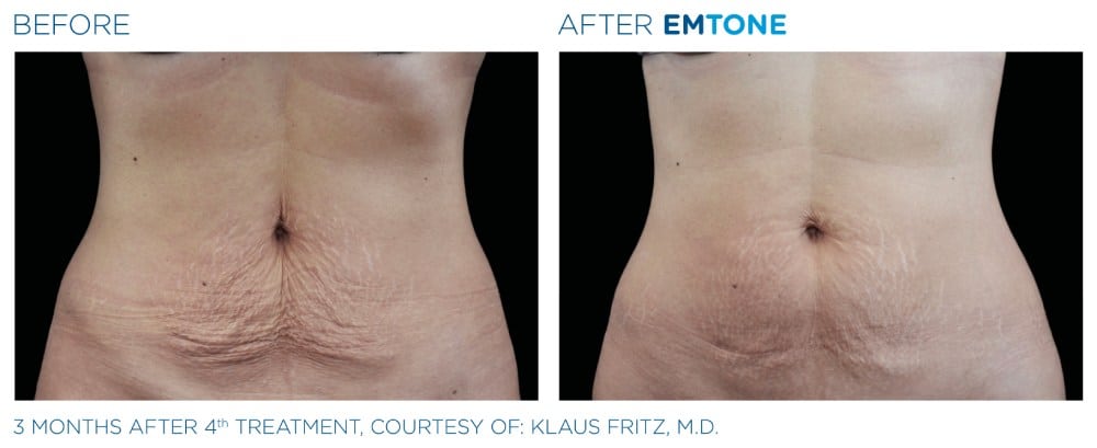 Emtone Before and After | Real Patient Results