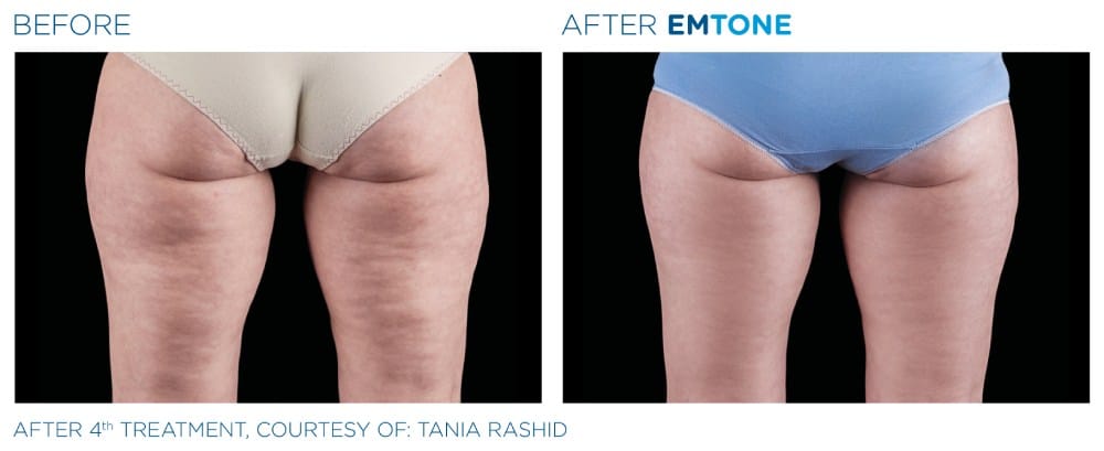 Emtone results before and after treatment at Capitol Contours in Alexandria, VA.