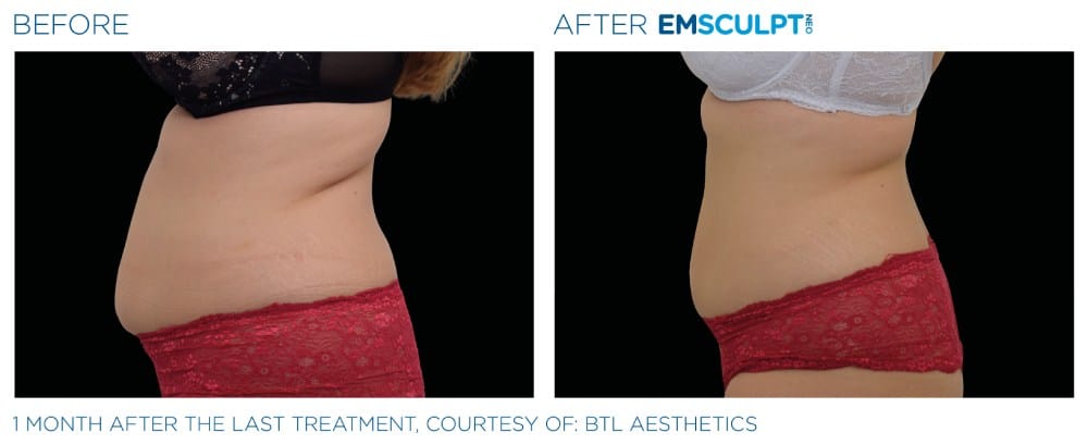 Emsculpt before and after results at Capitol Contours in Alexandria, VA.