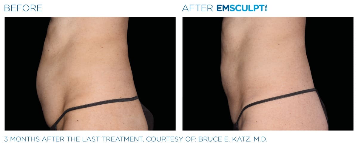 Emsculpt NEO Before and After 01