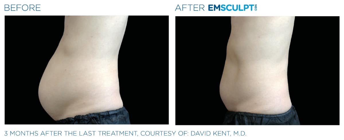 Emsculpt NEO Before and After 010