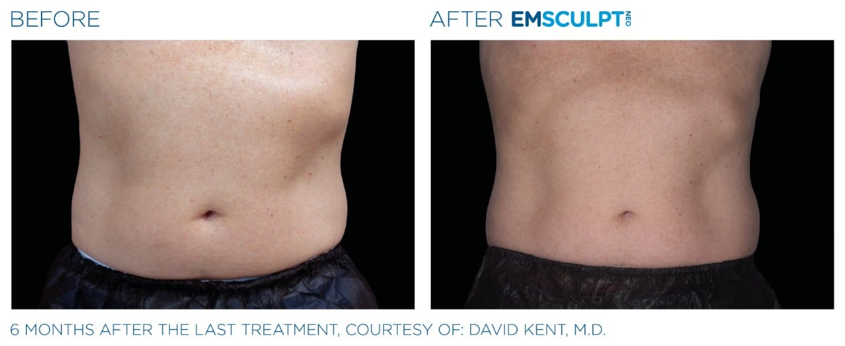 Emsculpt NEO Before and After 012