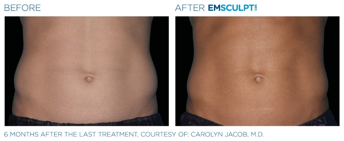 Emsculpt NEO Before and After 013