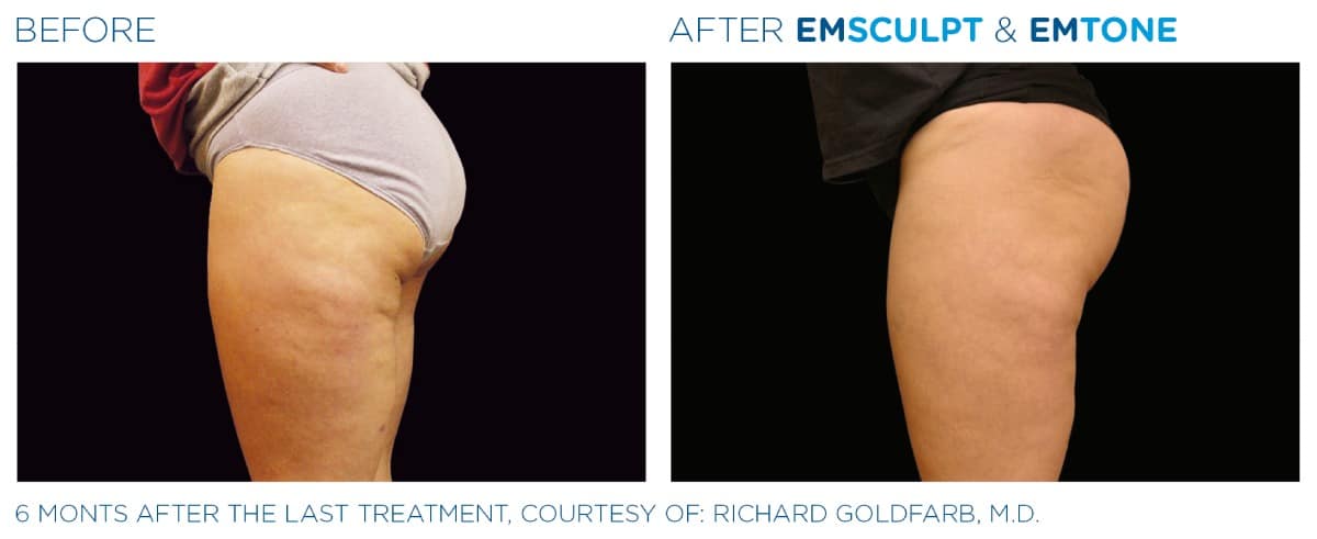 Emsculpt NEO Before and After 014