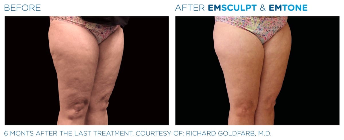 Emsculpt NEO Before and After 015