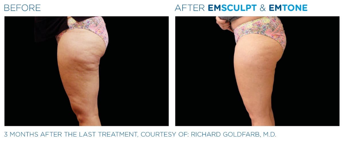 Emsculpt NEO Before and After 016