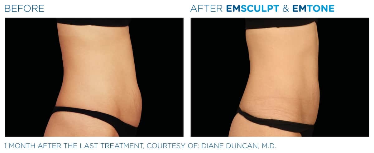 Emsculpt NEO Before and After 017