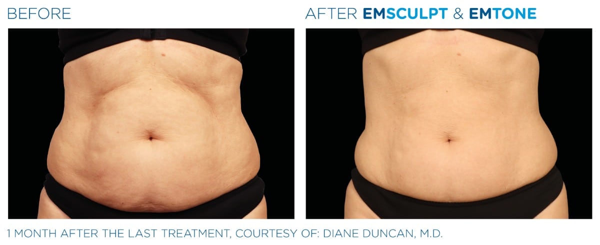 Emsculpt NEO Before and After 018