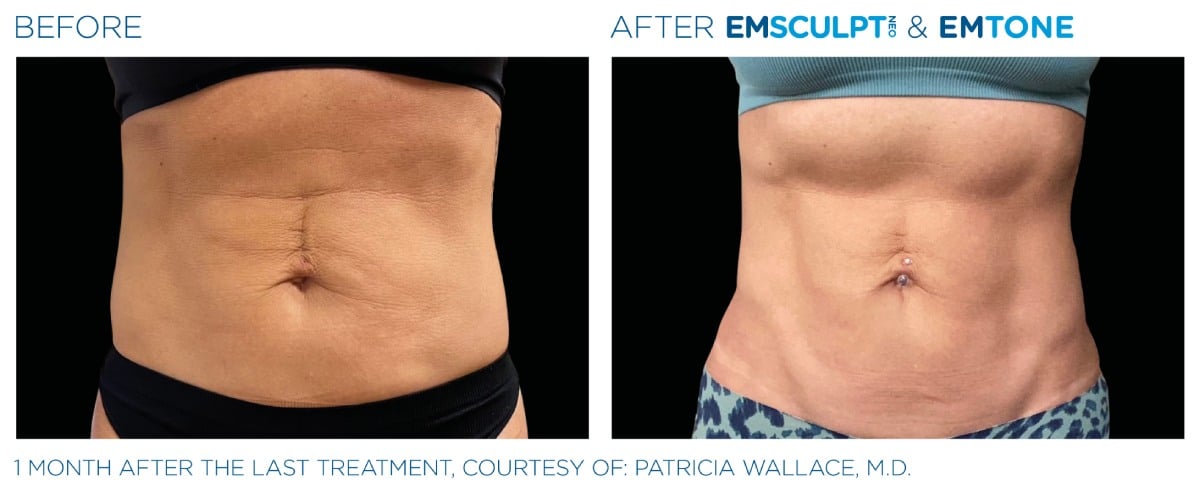 Emsculpt NEO Before and After 019