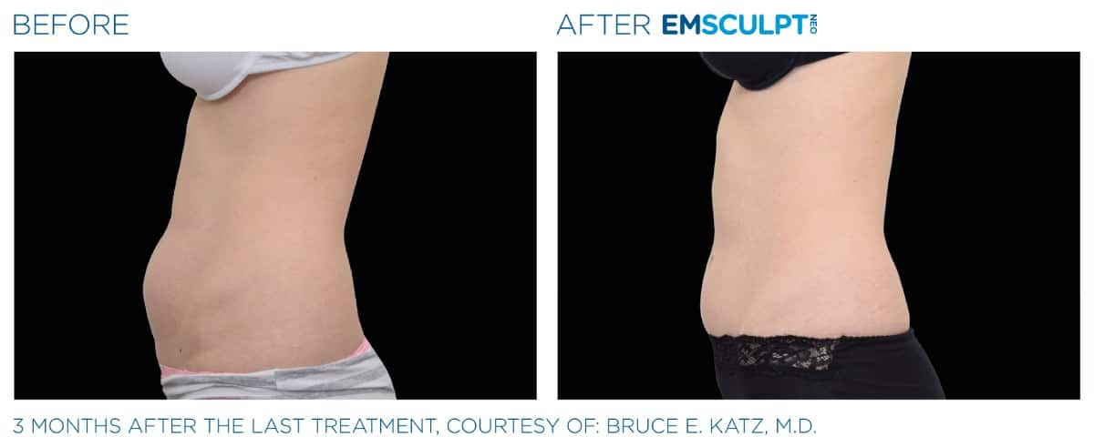 Emsculpt NEO Before and After 02