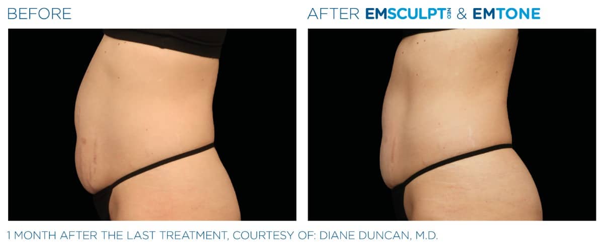Emsculpt NEO Before and After 020
