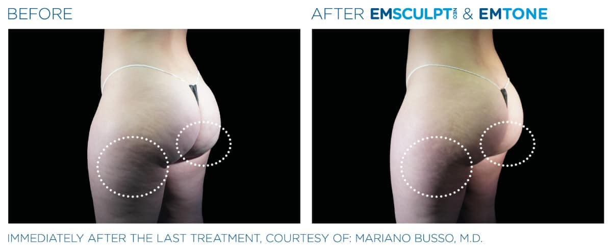 Emsculpt NEO Before and After 023