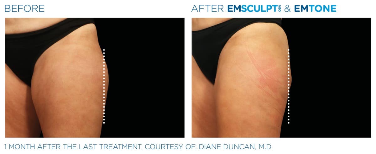 Emsculpt NEO Before and After 024