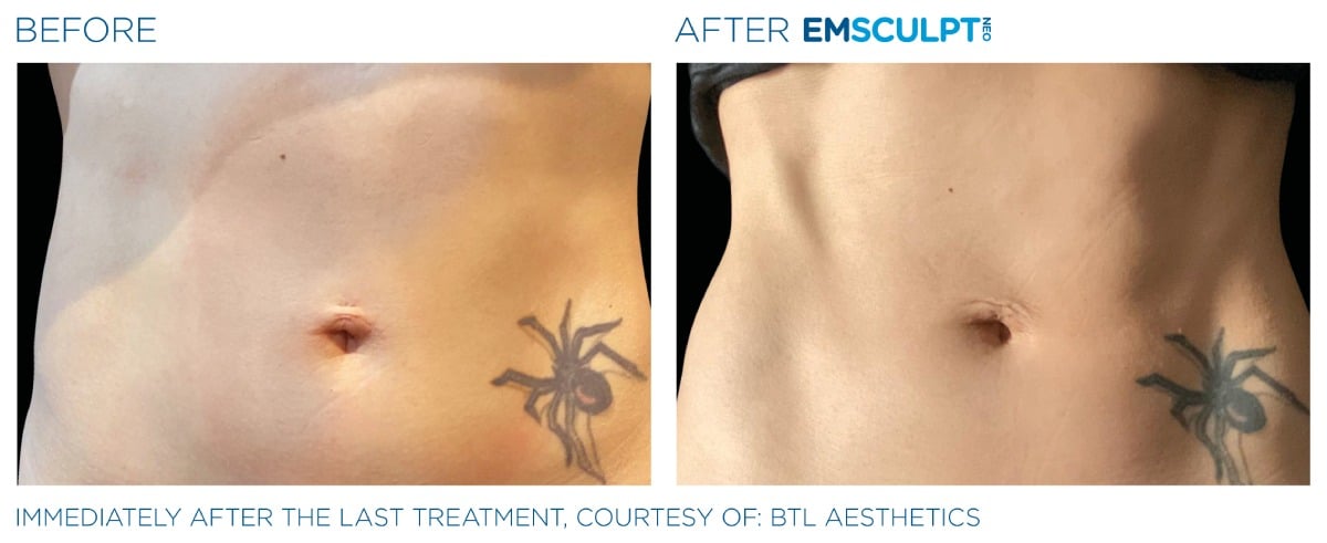 Emsculpt NEO Before and After 04