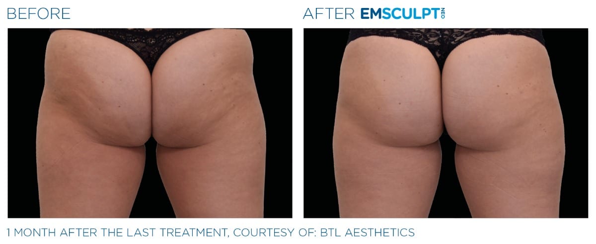 Emsculpt NEO Before and After 06