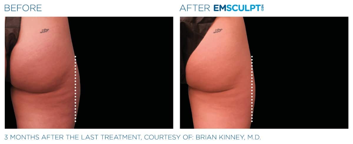 Emsculpt NEO Before and After 08
