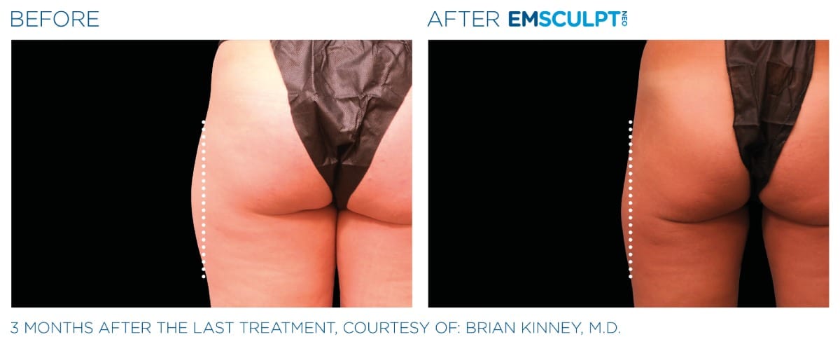 Emsculpt NEO Before and After 09