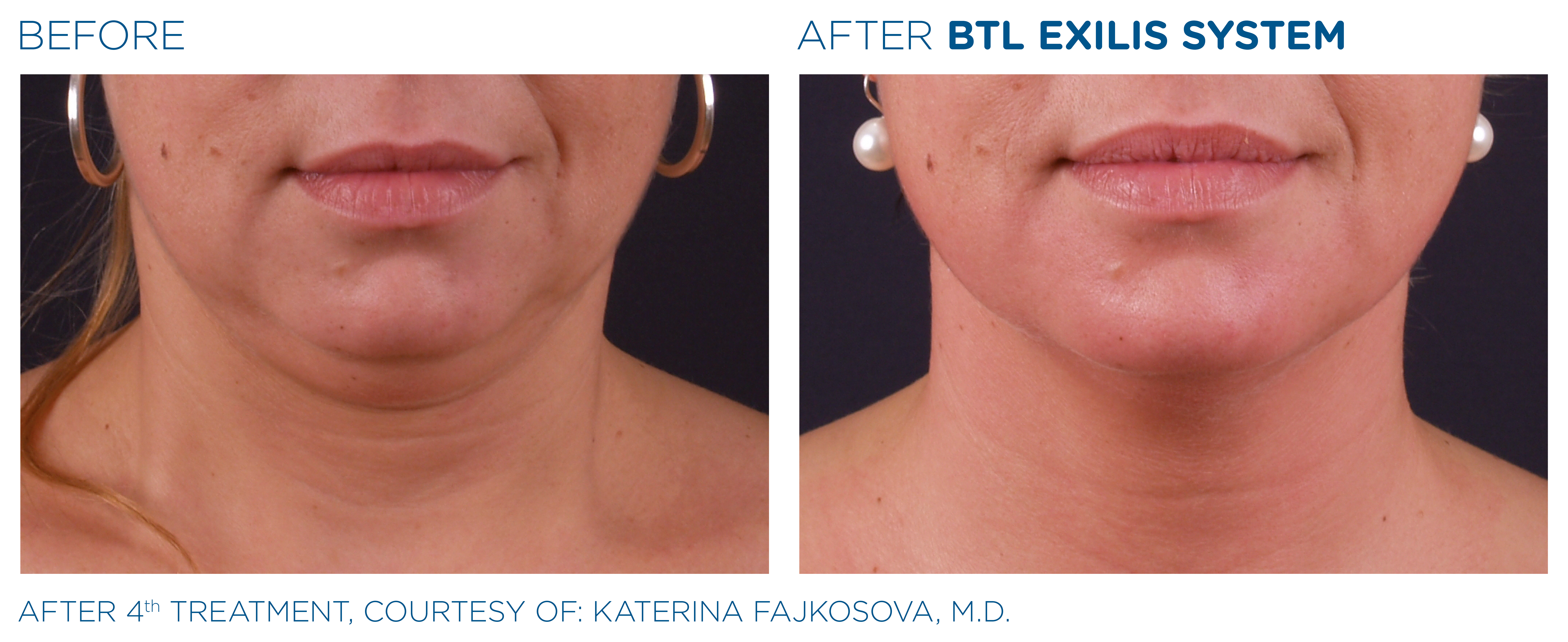before and after treatment with BTL Exilis System chin area