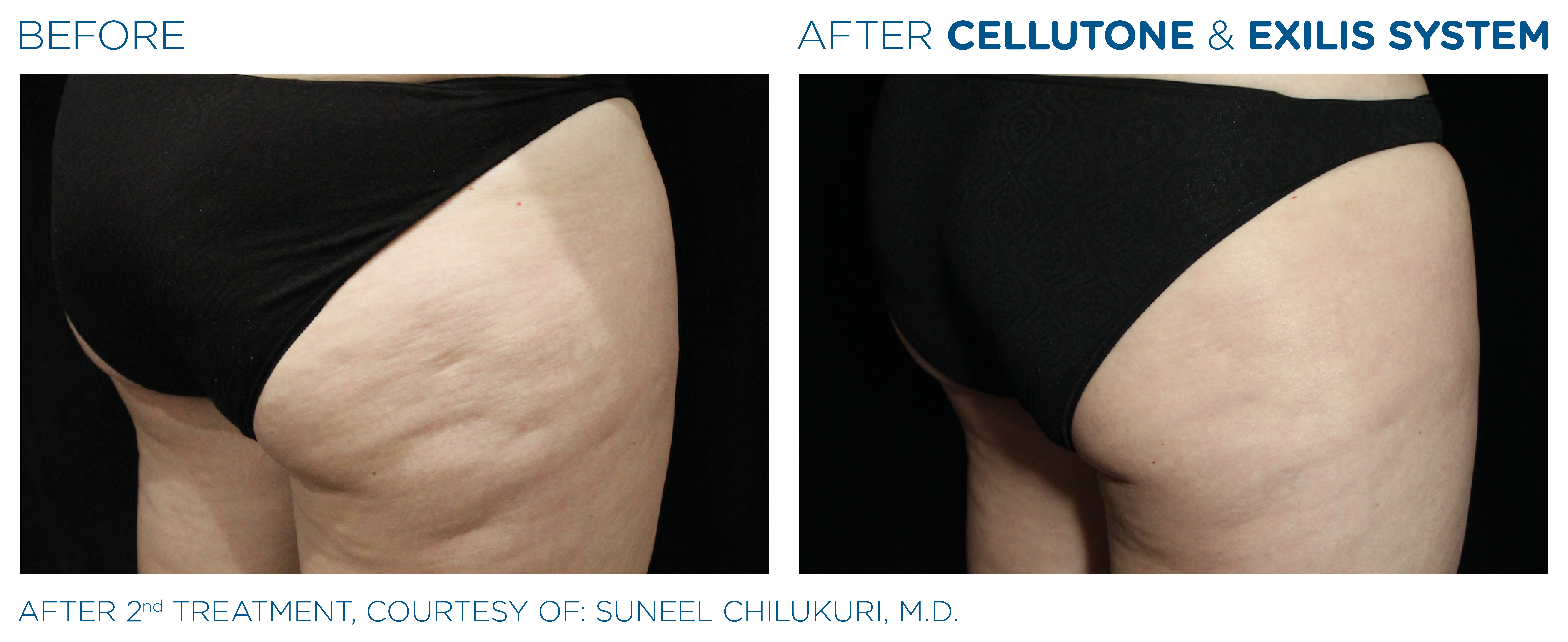 before and after treatment with Cellutone and Exilis System butt area