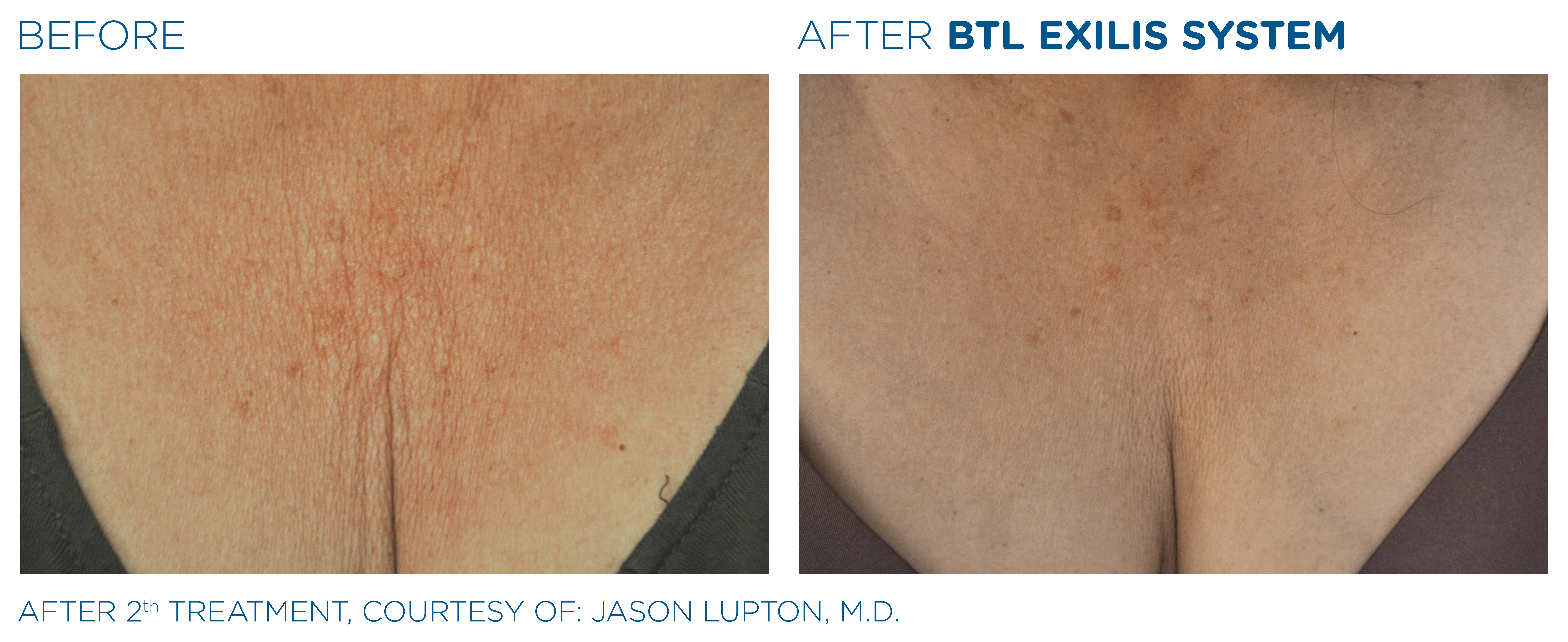 before and after treatment with BTL Exilis System chest area