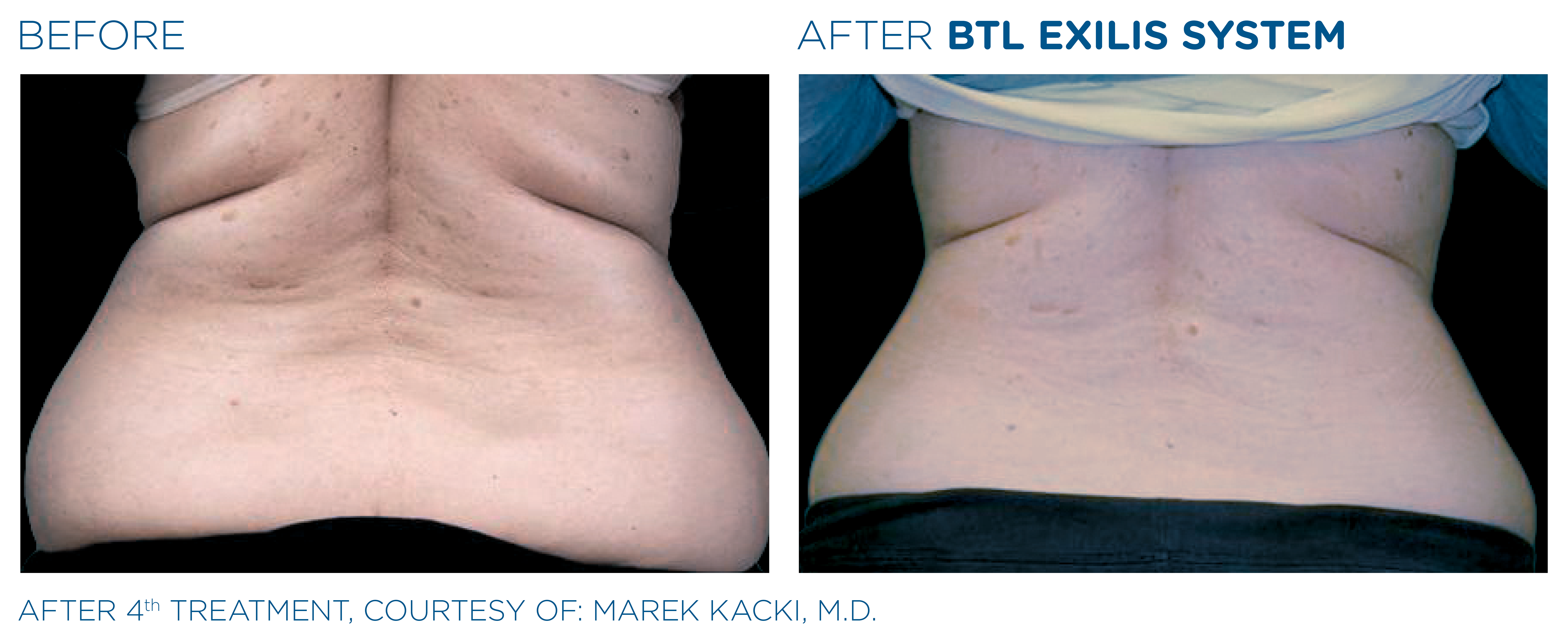 before and after treatment with BTL Exilis System love handles area