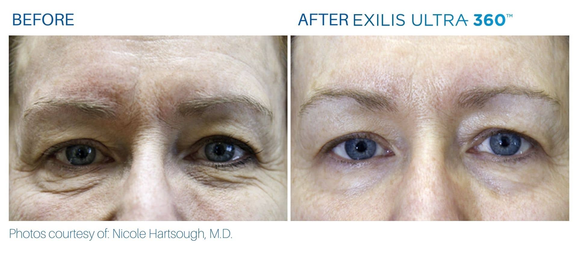 exilis ultra before and after treatment face area