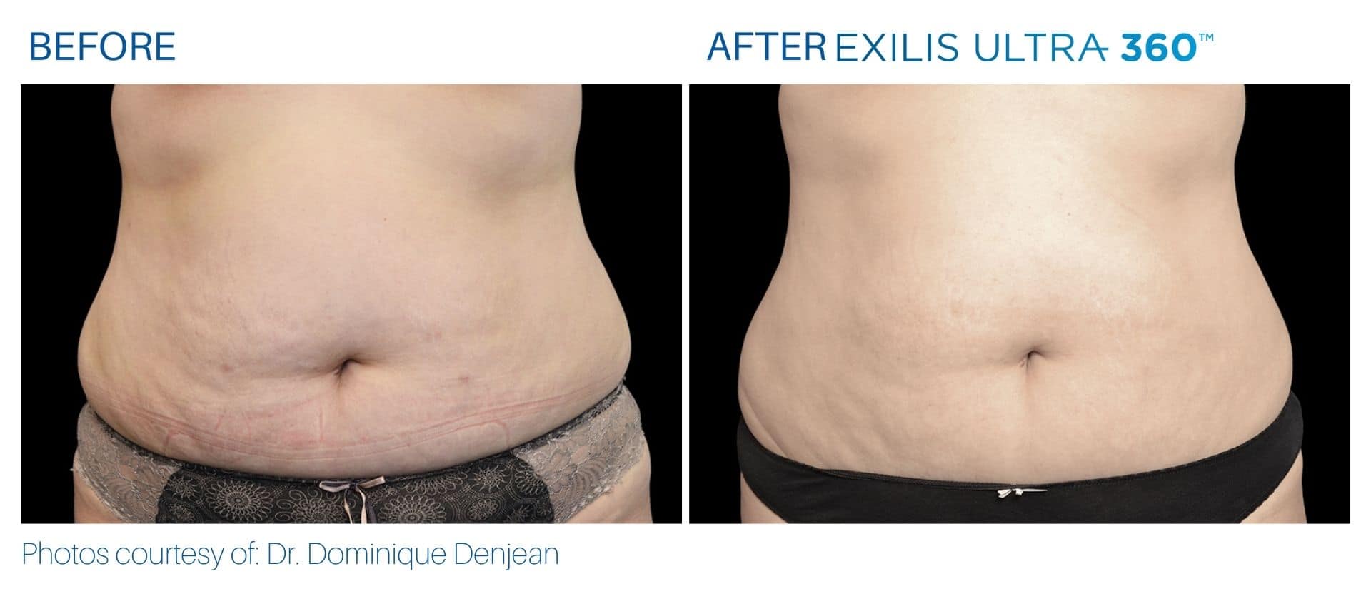 exilis ultra before and after treatment belly fat area