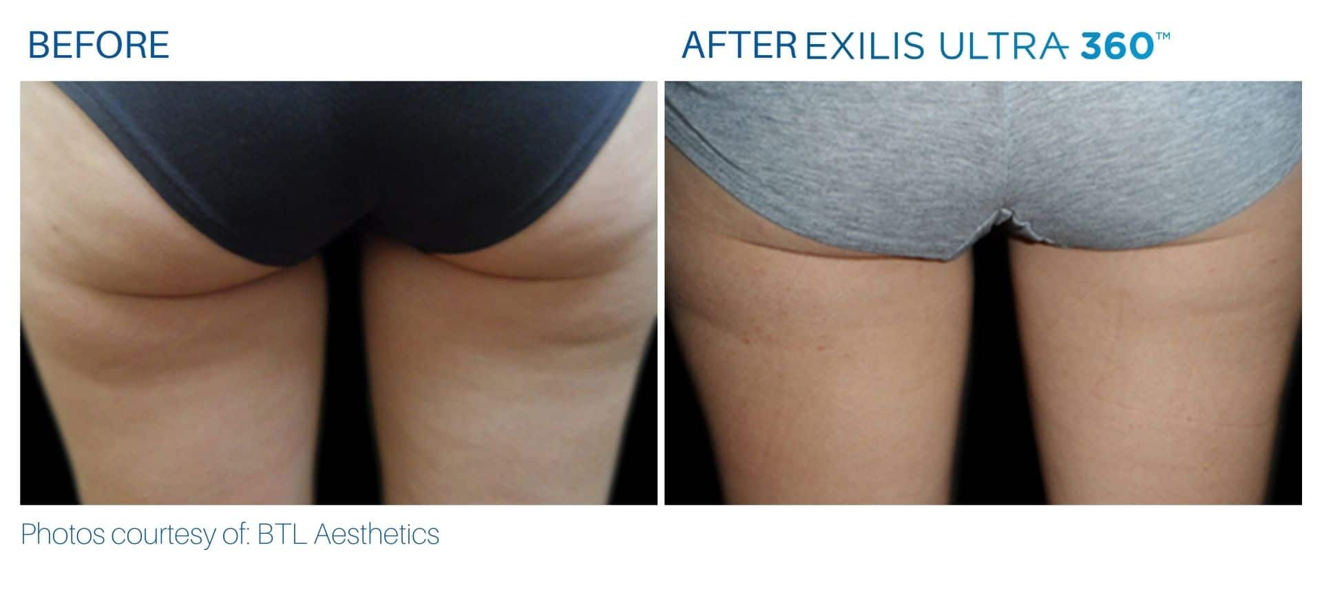 exilis ultra before and after treatment buttocks area